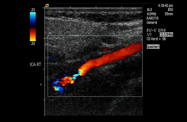 Ultrasound artery | Nepute Wellness