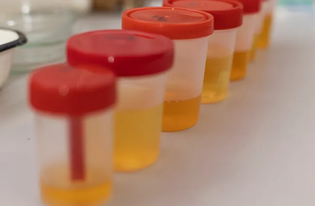 Urinalysis | Nepute Wellness