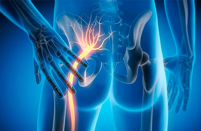 Sciatica | Nepute Wellness