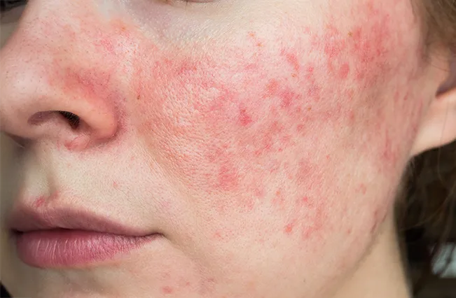 Skin problems | Nepute Wellness